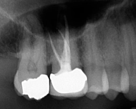 Radiograph of a tooth with root canal therapy.