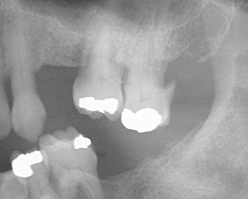 Radiograph with calculus visible.