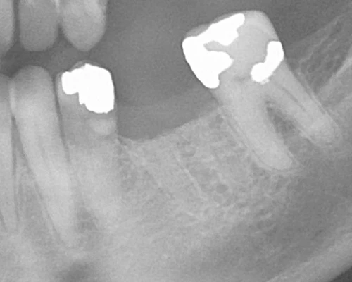 Radiograph of a recently extracted tooth with the socket visible.