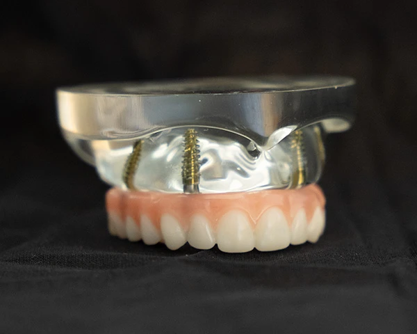 Fixed, full-arch prosthesis sameple.