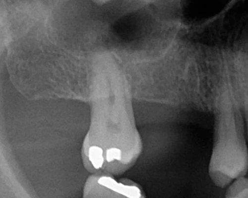 Radiograph of a maxillary molar in close proximity to the maxillary sinus.