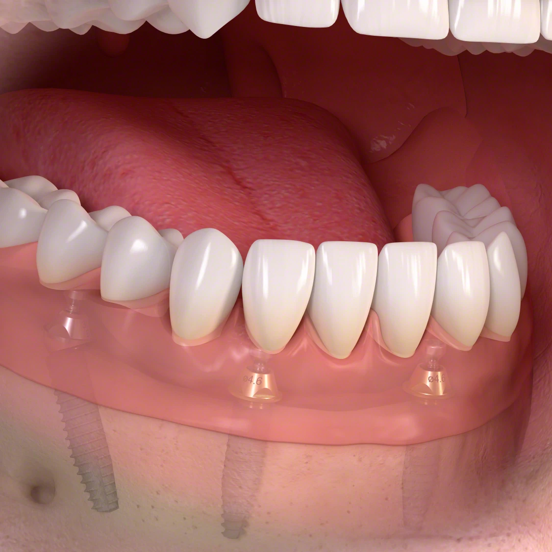 Stock image of a full arch tooth replacement