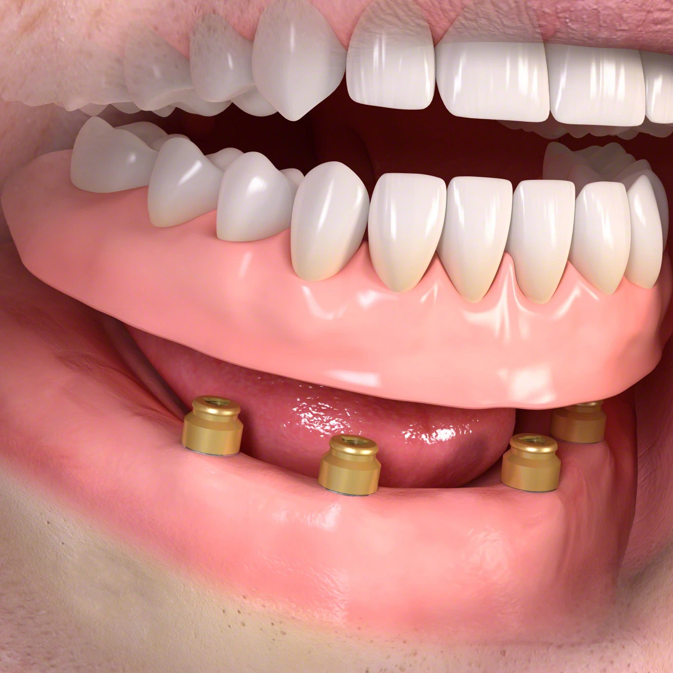 Stock image of an implant retained overdenture
