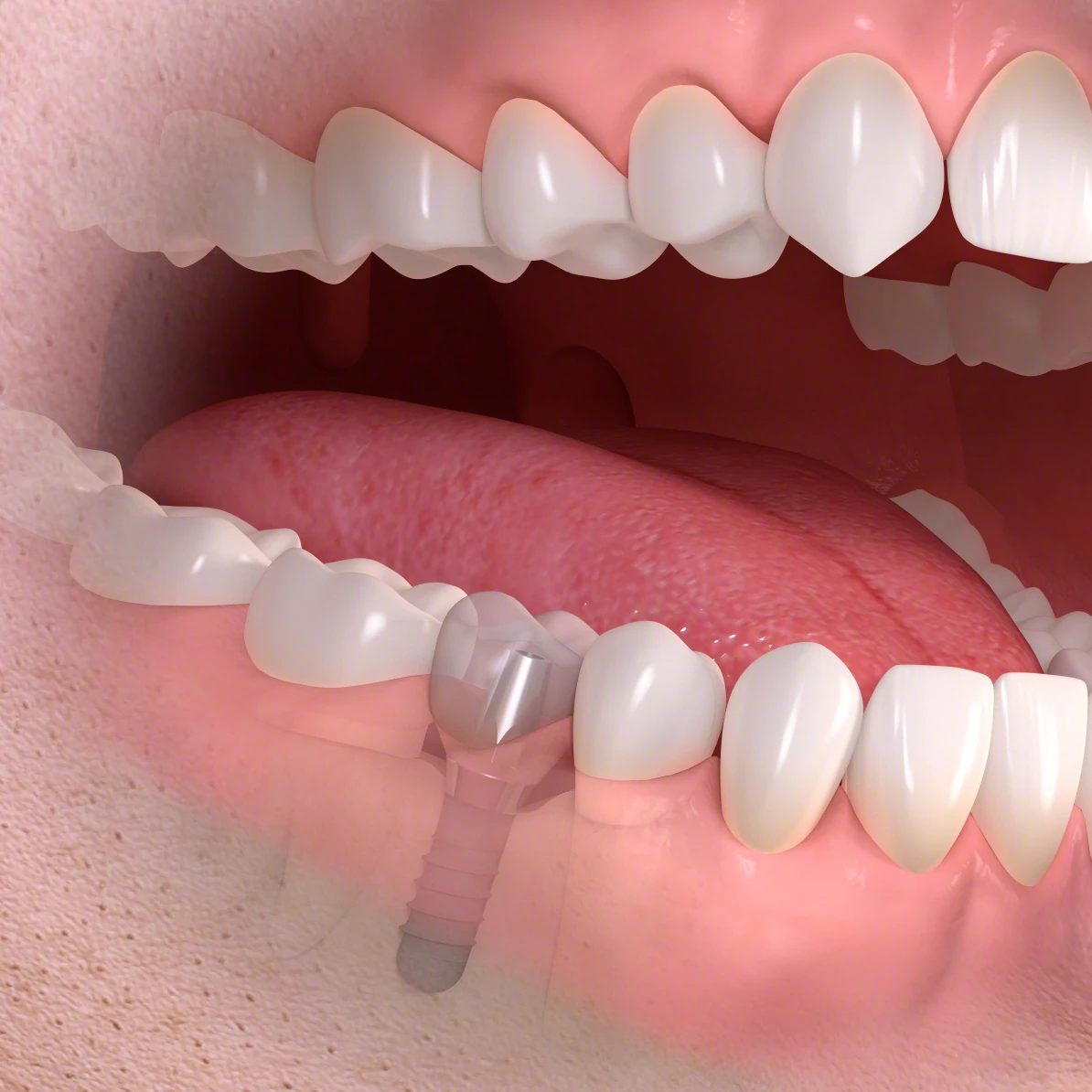 Stock image of a single tooth implant