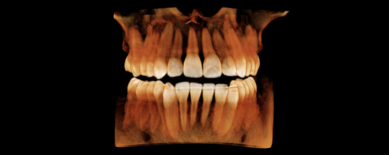 3D rendering of a patients full arch of teeth, reconstructed from a CBCT scan.