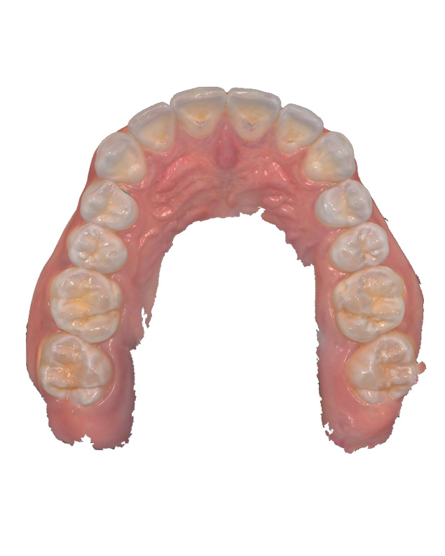 Intraoral scan of a patient's maxillary arch, viewed from the chewing surface.