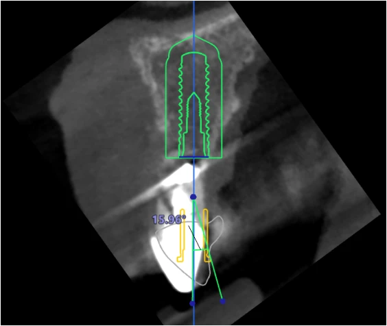 Digitally planning screenshot of a single tooth implant.