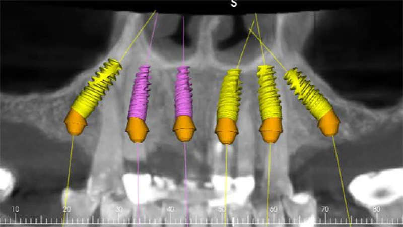 Screenshot of 6 digitally planned implants on a CBCT image of the maxilla.