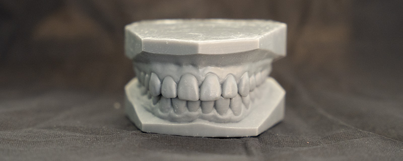 3D printed models of a patients mouth.