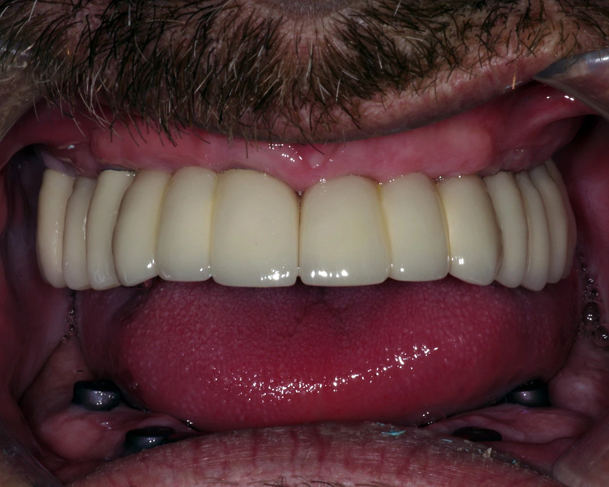 A full arch of full arch bridges on dental implants in a patients mouth with the cheeks retracted.