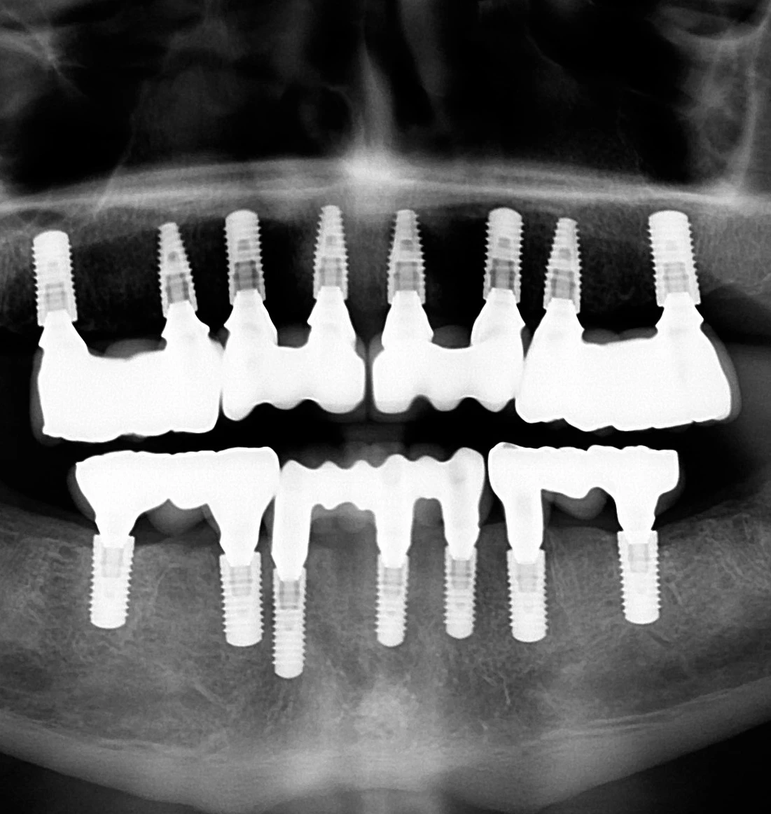 A radiograph of a fixed, full arch prosthesis