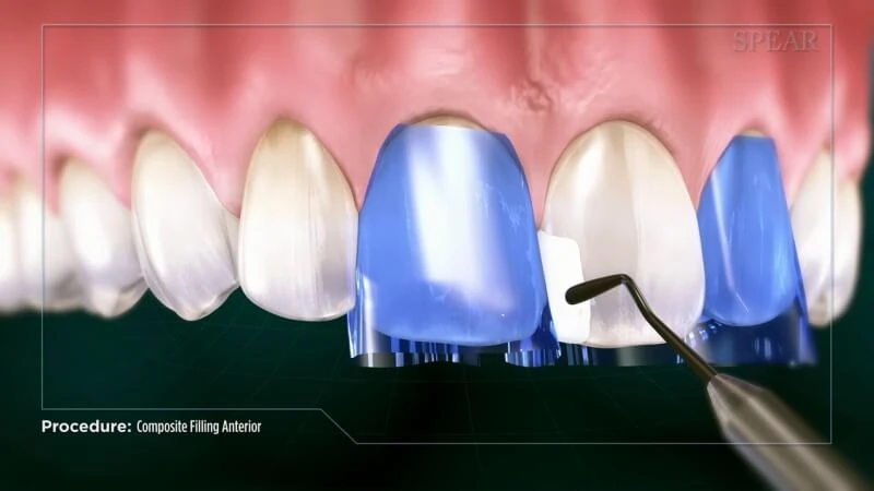 Tooth colored restorations (bonding)