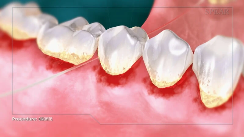 Gum disease (gingivitis)