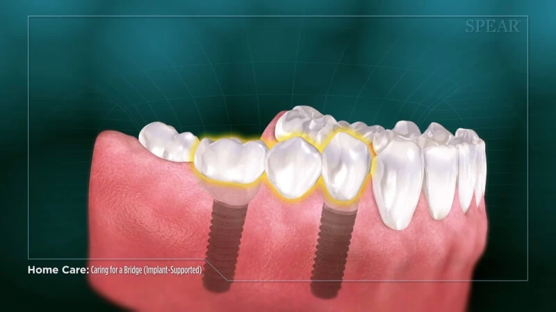 Caring for an implant supported bridge