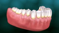 Periodontal maintenance appointment
