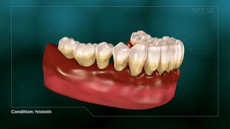 Gum disease (periodontitis)
